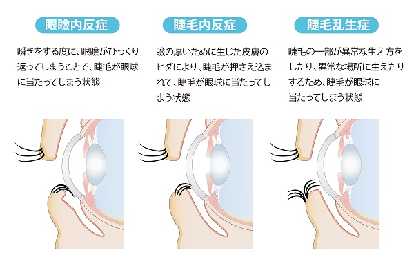 逆さまつげの種類