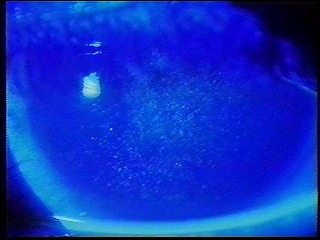 びまん性上皮角膜炎