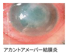 アカウントアメーバー結膜炎