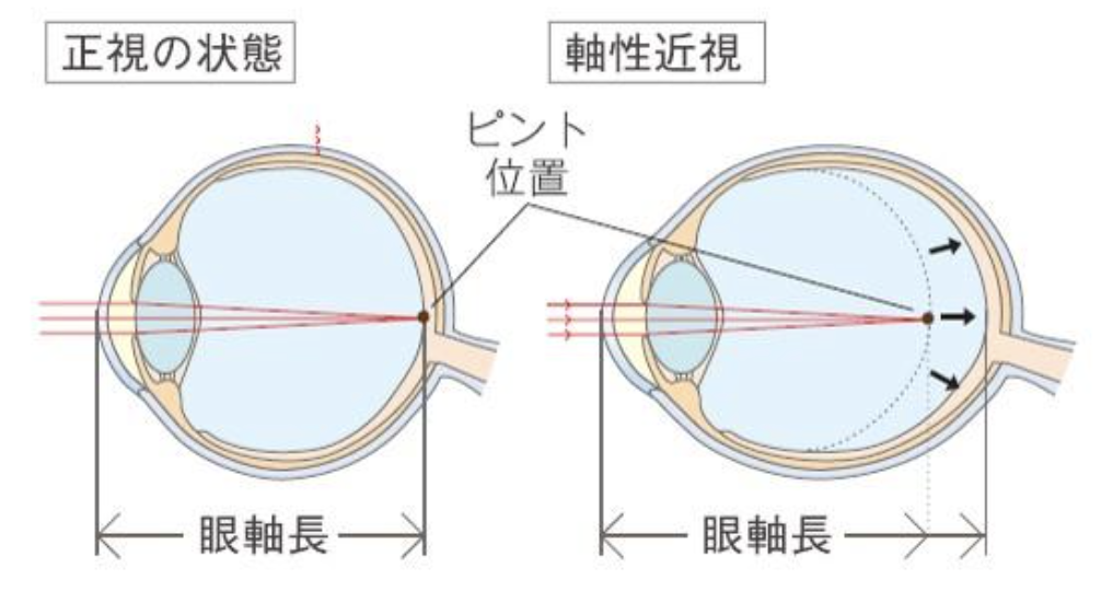 正視の目の状態と軟性近視の目の状態