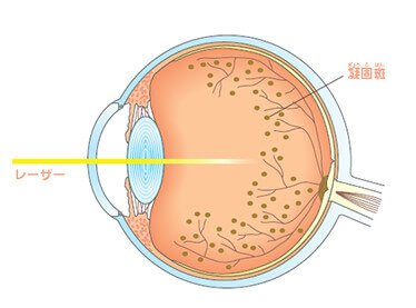 レーザー光凝固術のイメージ