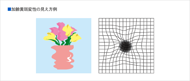 加齢黄斑変性の見え方