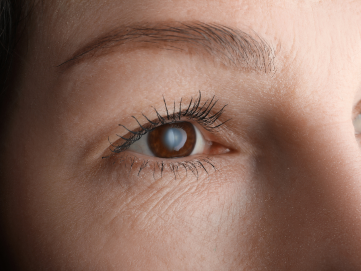 白内障により白く濁った瞳