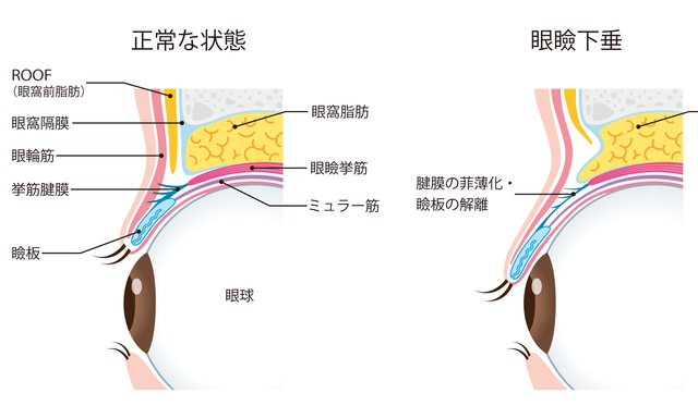 正常なまぶたと眼瞼下垂のまぶたイラスト