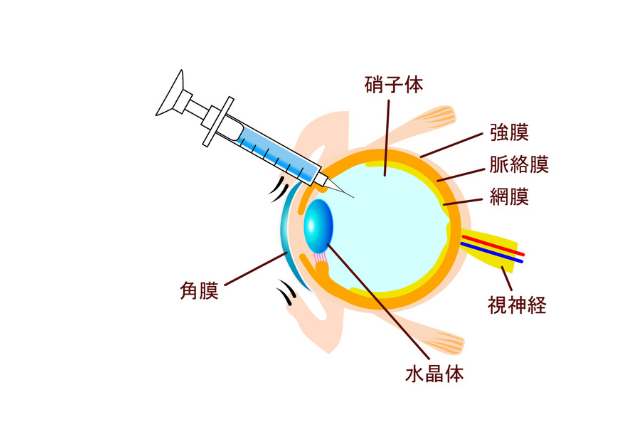 硝子体注射