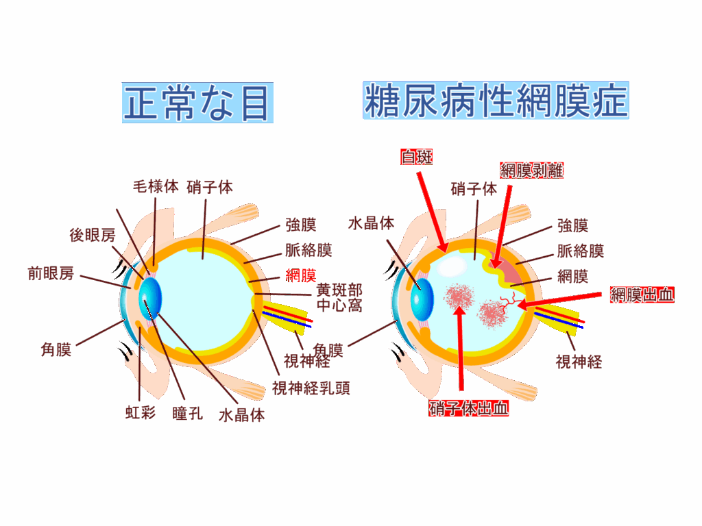 正常な眼内と糖尿病網膜症の眼内