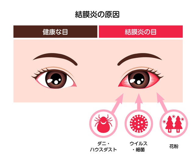 健康な目と結膜炎の目
