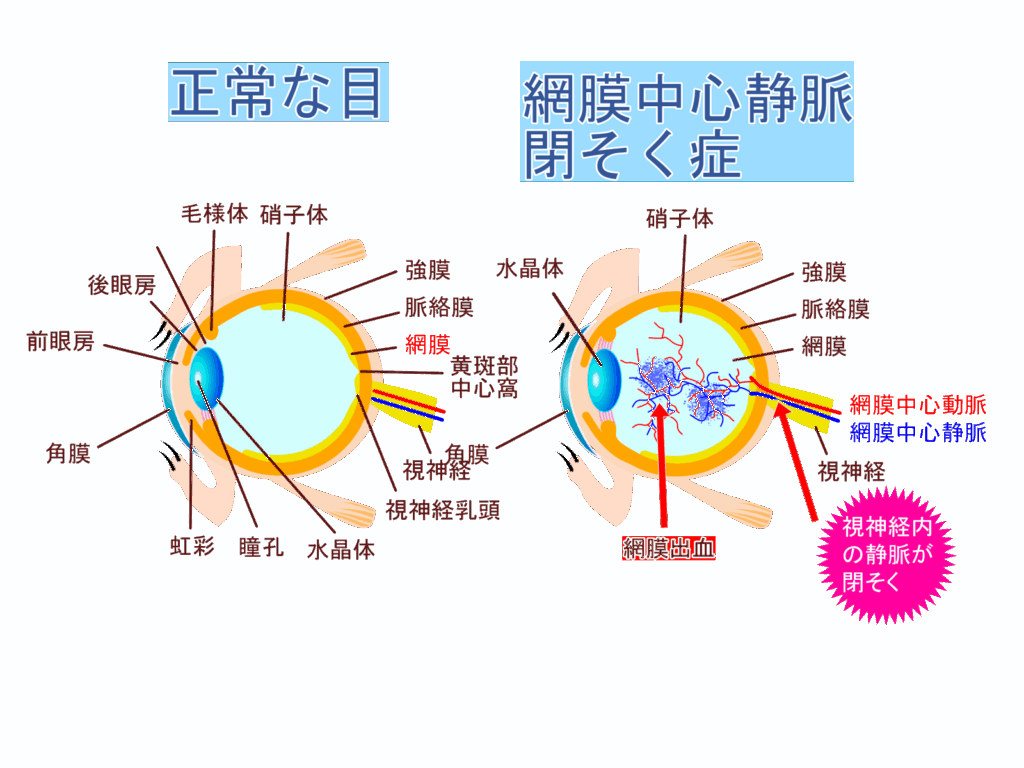 正常な目と網膜静脈閉塞症の目のイメージ