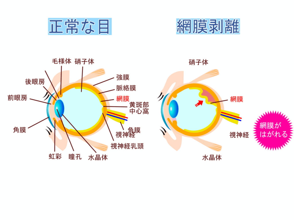 正常な眼内と網膜剥離の眼内
