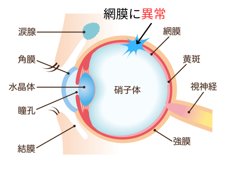 網膜色素変性症のイメージ