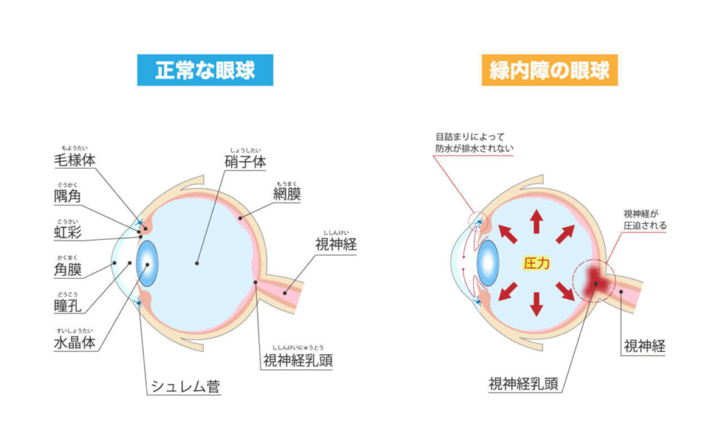 正常な目と緑内障の目