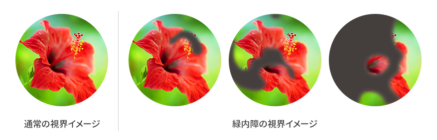 通常の視界と緑内障の視界