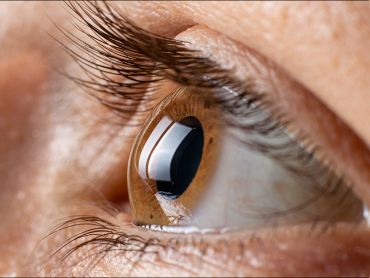 不正乱視｜角膜の異常