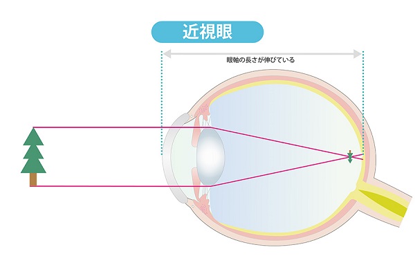 近視