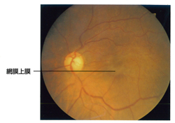 黄斑前膜（黄斑上膜）の症例