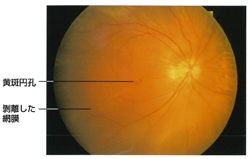 黄斑円孔の症例